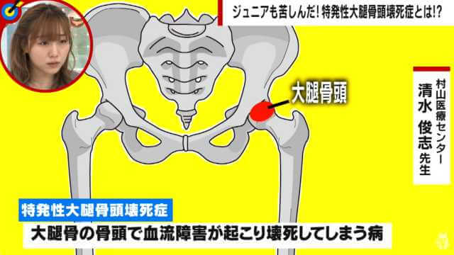 特発性大腿骨頭壊死症の図解