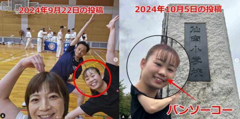 宮川紗江がほくろ除去した前と後の比較写真