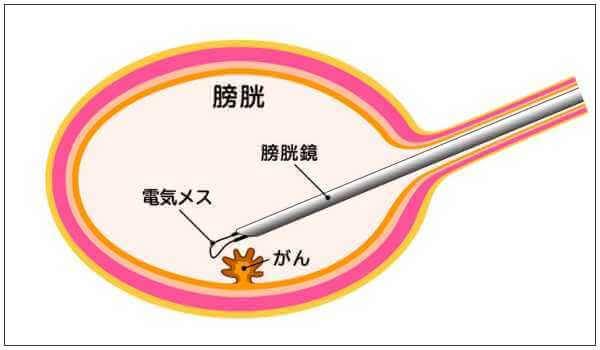 膀胱がんの内視鏡手術のイメージ図